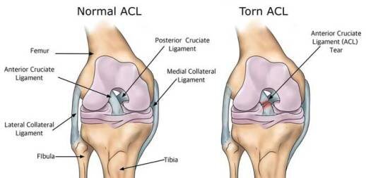 Normal-vs-torn-acl.jpg