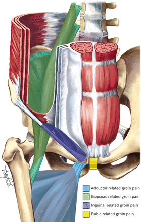 (Weir et al 2015, Doha agreement meeting on terminology and definitions in groin pain in athletes. https://bjsm.bmj.com/content/49/12/768)