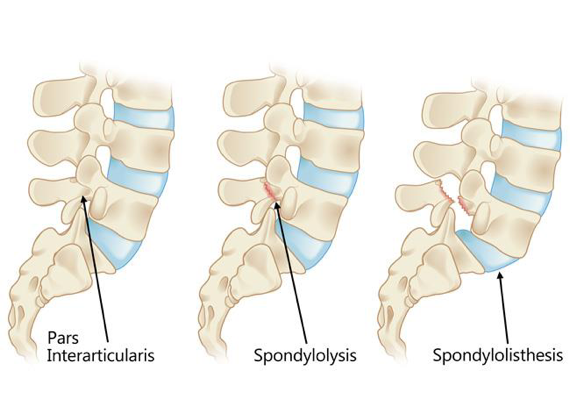 Persistent Lower Back Pain in Athletes? Watch Out for Spondylolysis